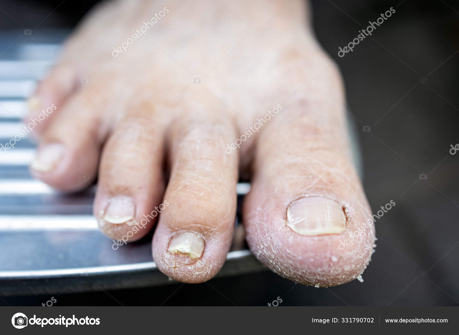 Asian senior woman have dry, cracked feet and broken nails in the