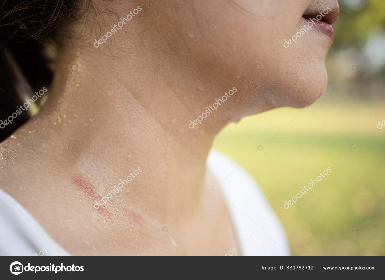 Female neck with sweat on skin,asian woman with atopic allergy skin