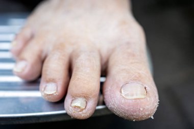 Asyalı son sınıf öğrencisinin ayakları kurumuş, ayakları kırılmış ve tırnakları kırılmış, yaşlılar kuru cilt, besin eksikliği, cilt eksikliği, pullu cilt, pürüzlü ayak, xerosis, sağlık konsepti
