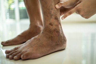 Kadın doktorun elleri, Asyalı yaşlı bir adamın bacağında varisli damar, vasküler hastalık, örümcek damarları, varis, yüzeysel damar sorunları, yaşlılar, şişmiş deri, kas ağrısı gösteriyor.
