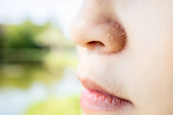 Алергічна молода жінка має екзему сухого носа в зимовий сезон, білий — стокове фото