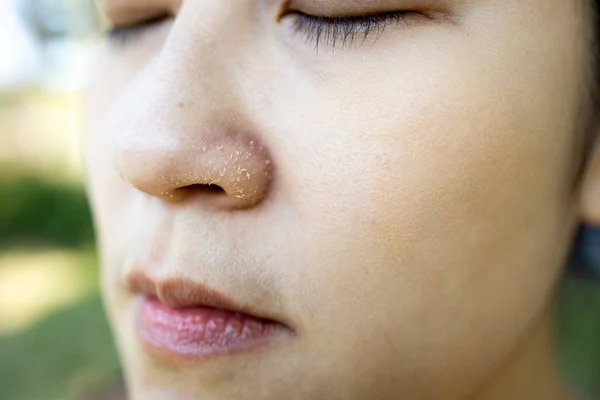 过敏的年轻女子在冬季有湿疹干鼻子，股骨 — 图库照片