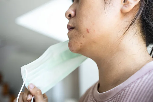 Азиатская Женщина Акне Лице Вызванной Носить Медицинскую Маску Накопление Грибов — стоковое фото