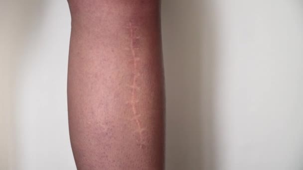 Die Narbe am Bein. Knochenbruch oder Tumorentfernung. Erholung — Stockvideo