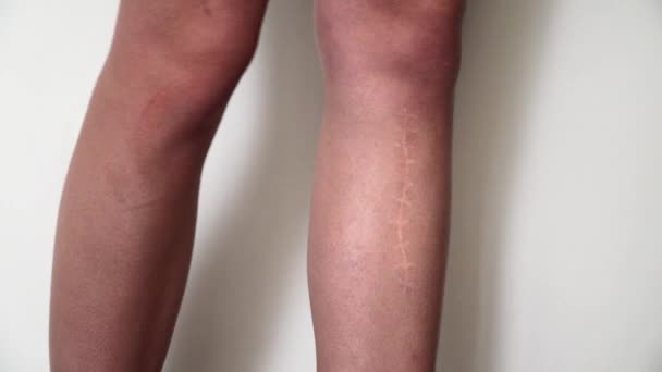 Die Narbe am Bein. Knochenbruch oder Tumorentfernung. Erholung — Stockvideo