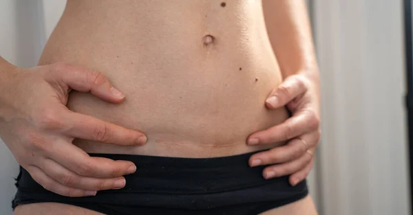 Kadınların karnında sezaryen izi. Cerrahi yolla doğum yapmak. Doğum Sonrası Kurtarma