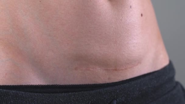 Close up de barriga de mulheres com cicatriz de cesariana. Recuperação pós-parto. Operação de entrega de bebés. Mulher apta após o nascimento — Vídeo de Stock