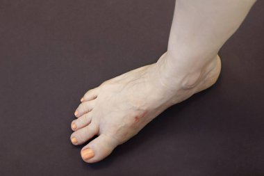 Travma ya da ameliyattan sonra eşarplı bir kadın, sıkı ayakkabılar, deformasyon harika ayak parmağı ya da ilk metatarsophageal eklem, hallux valgus ya da nasır. Boşluğu kopyala, seçici odak, koyu arkaplan.
