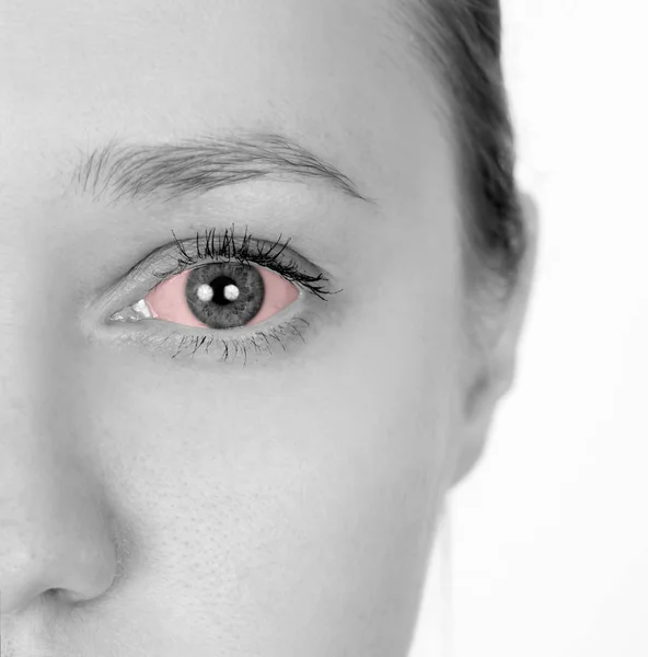 Girl has red eyes. Disease of the eyeball