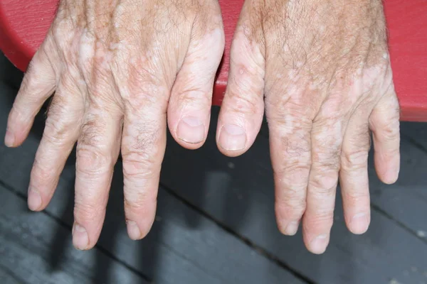 Hand met vitiligo-huid — Stockfoto