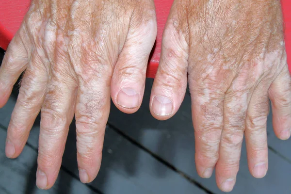 Hand met vitiligo-huid — Stockfoto