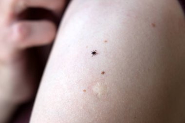 Tehlikeli bir ensefalit kenesi (Ixodes ricinus) bir insanın ön kolunda sürünür.