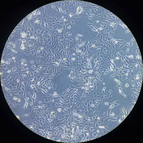 Kanser hücreleri mikroskop altında