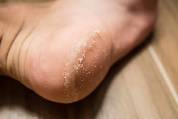 topuk hastalığı yakın