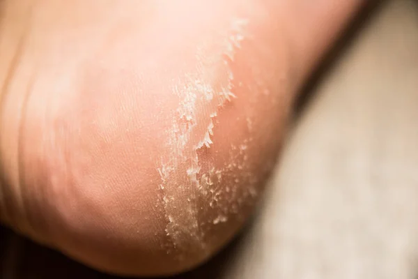 topuk hastalığı yakın