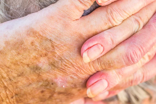 Händerna på gammal kvinna med hudproblem — Stockfoto