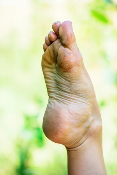 Dry dehydrated skin on the heels of female feet with calluses — Stock Photo, Image