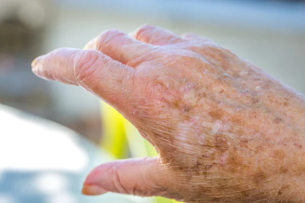 Handen van oude vrouw met huidproblemen — Stockfoto