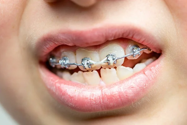Zbliżenie Zęby Nawiasami Ortodontycznymi Opieka Stomatologiczna — Zdjęcie stockowe