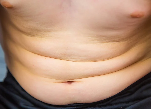 Close Child Belly Showing Overweight Early Signs Obesity — Stock Photo, Image