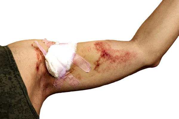 Closeup Bandaged Arm Bandaged Injury Forearm Using White Bandage — Stock Photo, Image