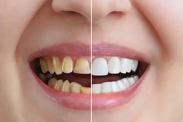 Behandling Och Blekning Tänder Tandkronor Före Och Efter Tandvård Närbild — Stockfoto