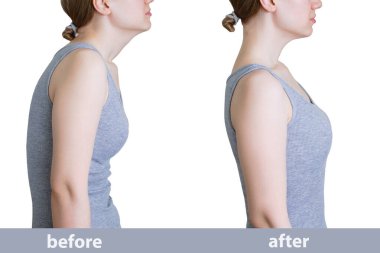 Curvature of posture. Direct posture. Caucasian woman in gray tank top before and after. clipart