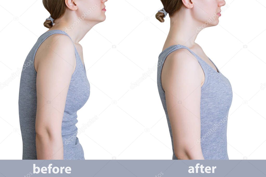 Curvature of posture. Direct posture. Caucasian woman in gray tank top before and after.