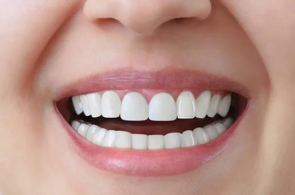 Dientes Blancos Una Mujer Caucásica Después Del Tratamiento Blanqueamiento Dientes —  Fotos de Stock