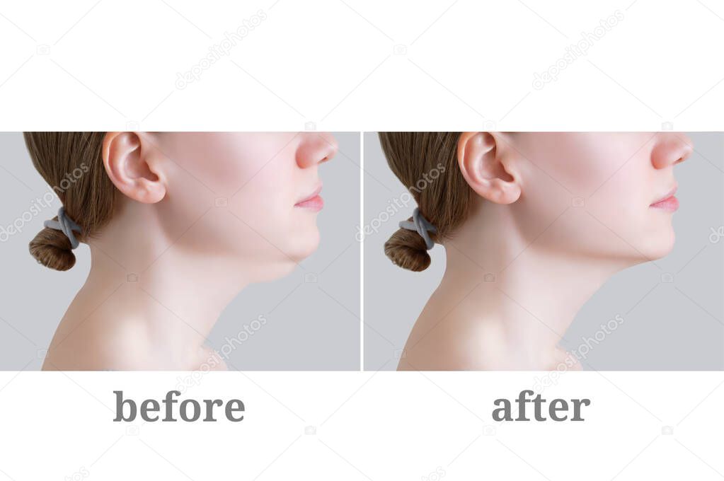 Double chin in a young Caucasian woman. Photos before and after surgery.