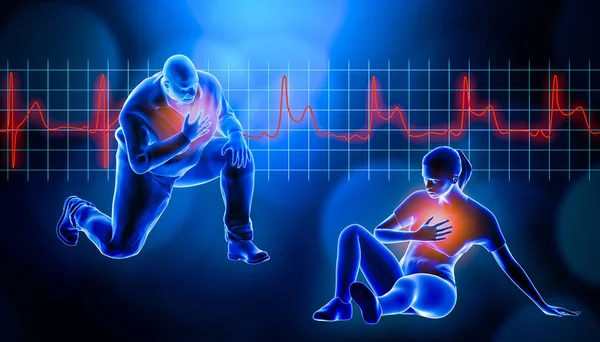 Obeso de hombre gordo arrodillado mientras que sufre de un ataque al corazón 3d representación ilustración. Frecuencia cardíaca del IAMCEST ECG en segundo plano y espacio de copia. Médico y sanitario, concepto de infarto de miocardio . — Foto de Stock