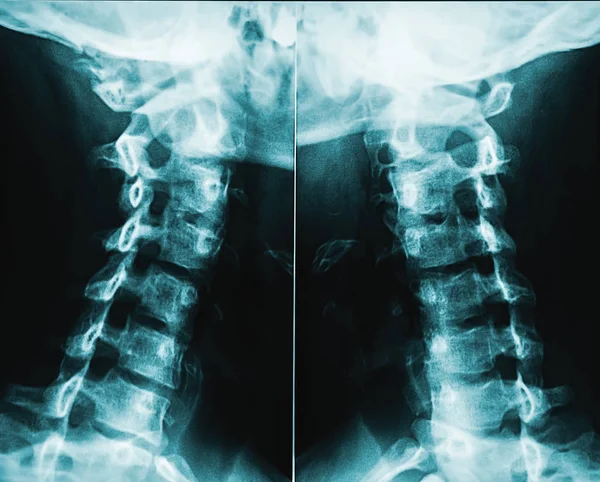 X-ray image or radiography of human male neck vertebrae or cervical rachis. — Stock Photo, Image