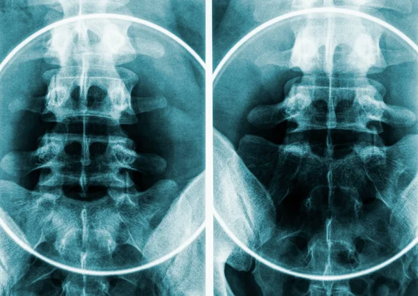 Emberi férfi medence és ágyéki csigolyák röntgenképe vagy radiográfiája. — Stock Fotó