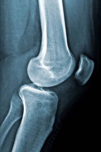 男性は膝の放射線グラフまたはX線垂直画像を残しました。医療・医療画像. — ストック写真