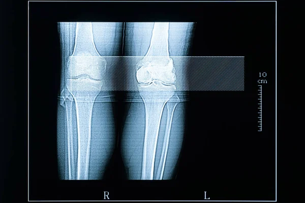 Young Male (25 years old) left and right knees CT scan. Medical and healthcare imagery with scale in centimeters. — Stock Photo, Image