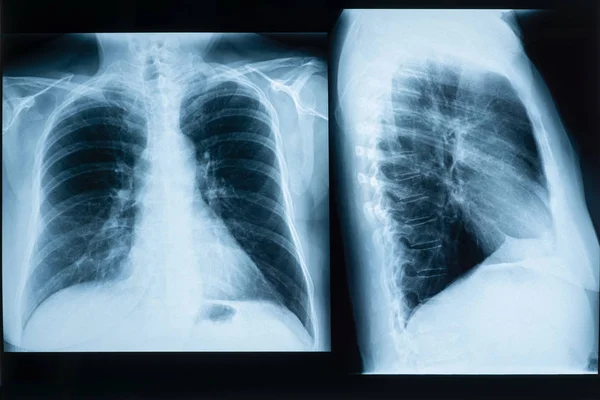 Mujer sana pulmones radiografía o radiografía. Imágenes médicas y sanitarias . — Foto de Stock