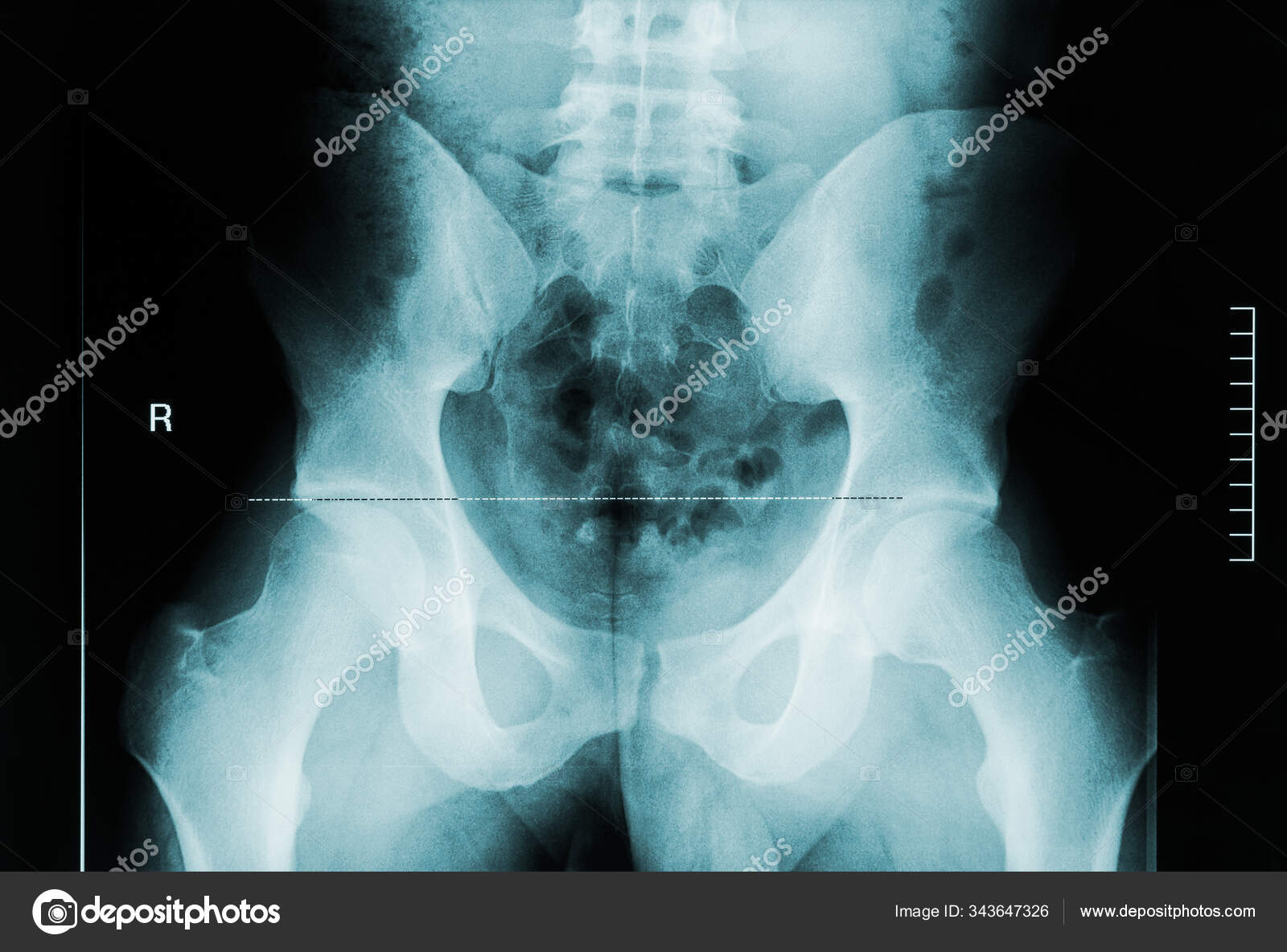 뒤에서는 남성 골반 대퇴골 척추뼈 의 x 선 사진을 볼 수있습니다 의학 과 인간 해부학적 형상 스톡 사진
