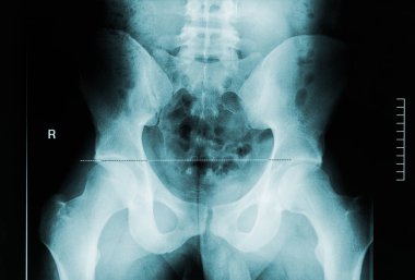 Erkek leğen kemiğinin, uyluk kemiğinin ve bel omurunun röntgen görüntüsü. Tıbbi ve insan anatomisi tasvirleri.