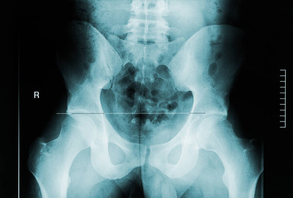 Back view x-ray image of male pelvis, femoral neck and lumbar vertebrae. Medical and human anatomy imagery.