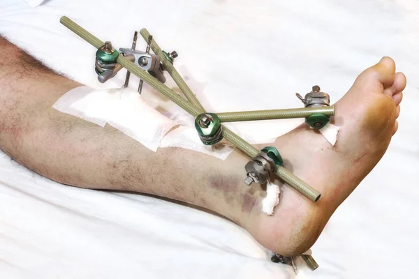 Мужская Нога Ортопедическими Металлическими Стержнями Образующими Фиксированную Скобу — стоковое фото