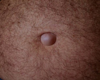 Medical examination of the patients umbilical hernia of the abdomen