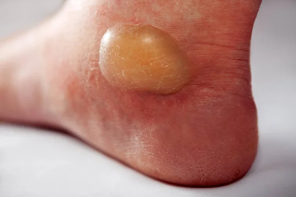 大きな水疱と焼けた足 — ストック写真