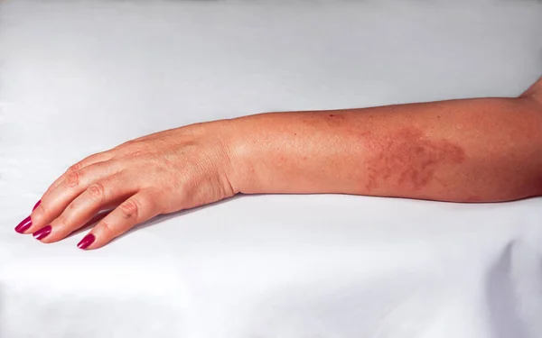 Redness from burn on woman hand — Stock Photo, Image