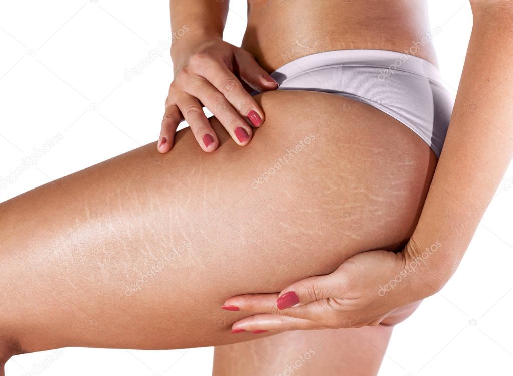 Stretch marks on woman's legs