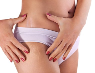  stretch marks on female hips clipart