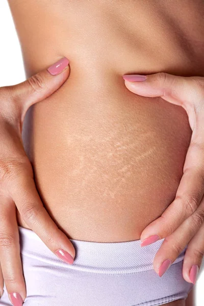 Stretch marks on female skin — Stock Photo, Image