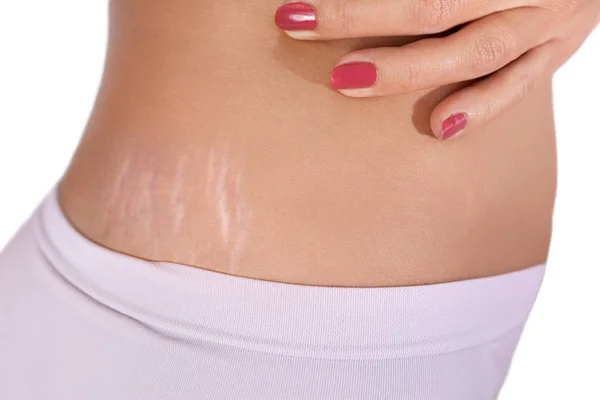 Close-up van stretch marks — Stockfoto