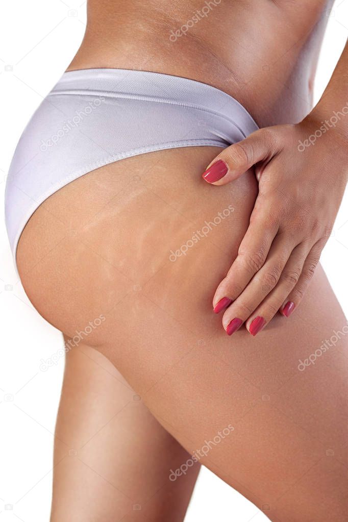 Womans thigh with stretch marks 