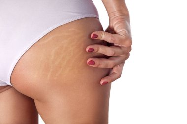 Woman buttocks with stretch marks and cellulite clipart