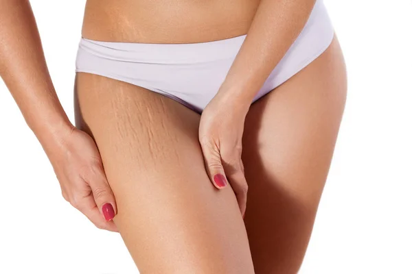 Woman showing stretch marks — Stock Photo, Image